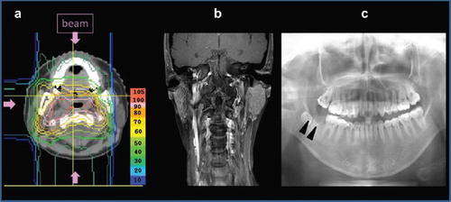 Figure 3. Proton beams were delivered via 3 ports (a). The right parotid gland (b) and the right lower back teeth (Δ:c) in the treatment field showed atrophy on the MRI and the dental panoramic radiography.