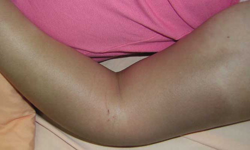 Fig. 1.  The picture shows erythematous swelling over lateral aspect of left distal arm, elbow, and forearm. There were three needle punctures over lateral aspect of the elbow.