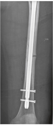 Figure 1. Left femur. Atypical fracture while using alendronate, 2008.