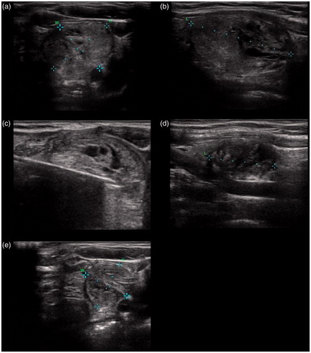 Figure 2. Ultrasound imaging before microwave ablation (MWA) (a, b), whilst MWA (c) and after 3 months (d, e). Nodule volume prior to MWA was 14.22 mL (43 × 28 × 23 mm) and 5.0 mL (27 × 19 × 19 mm) afterwards.
