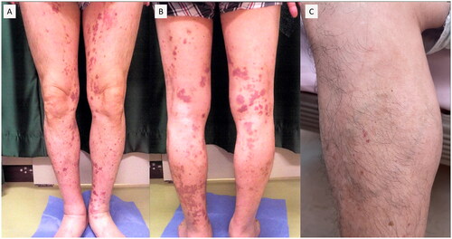 Figure 1. Scattered purpura was observed on both lower extremities; and was not resolved by acupressure, some of which had faded away leaving hyperpigmentation.
