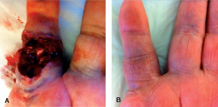 Figure 2. Dupuytren’s contracture of the right small finger (extension deficit, 75° in the metacarpophalangeal and 70° in the proximal interphalangeal joint) in a 75-year-old man. A. 2 days after injection, immediately after finger extension. B. 30 days after finger extension.