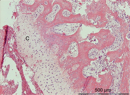Figure 4. The most prominent occurrence of cartilage (C) in the study. It is located between woven bone and a necrotic hematoma. There appears to be a gradual transition from woven bone, via fibrocartilage, to hyaline cartilage.