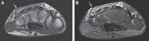 Figure 1. (a) Preoperative axial T1-weighted (b) and T2-weighted MR images showing heterogeneous hyperintense well-defined mass (arrows), which has similar intensity with subcutaneous fat tissue, adjacent to extensor digitorum tendon.