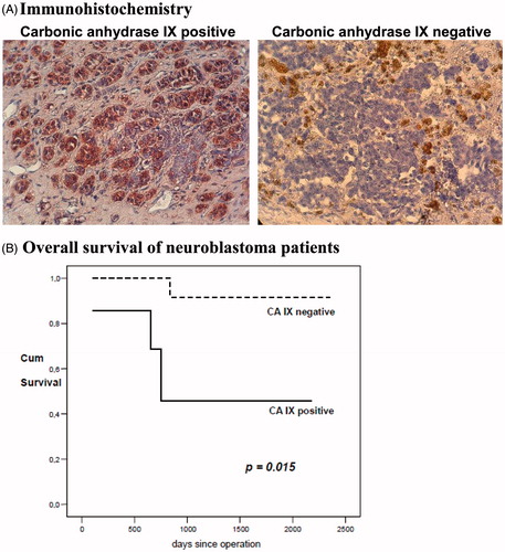 Figure 1. Expression and impact on survival of carbonic anhydrase IX. (A) Immunohistochemistry: Representative images of carbonic anhydrase IX positive and negative immunohistochemical staining of neuroblastoma tissue are shown (20× standard microscopic enlargement). (B) Overall survival: For the Kaplan-Meier survival analysis, patients were grouped according to positive and negative carbonic anhydrase IX expression. Overall survival of neuroblastoma patients with no carbonic anhydrase IX expression was significantly better than that of carbonic anhydrase IX positive patients (p = 0.015).