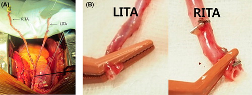 Figure 2. A composite Y-graft using the BITA: The RITA is long enough to reach the distal left anterior descending artery (A). The diameter of the RITA is larger than that of the LITA because the end of the RITA is usually within two-thirds of the entire RITA (B).The more proximal and larger portion of the RITA can be used for the left anterior descending artery rather than the LITA.