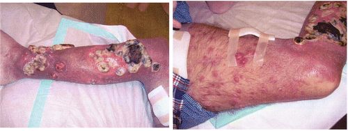 Figure 7. Photograph of the tumour lesions seven weeks after treatment.