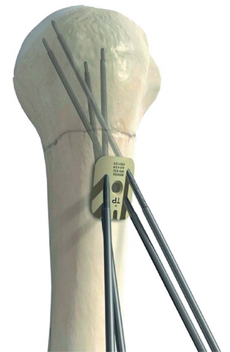 Figure 1. Management concept for proximal humeral fractures with an angle-stable skewed arrangement of Kwires.
