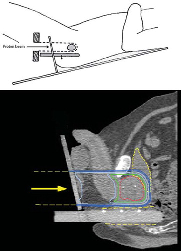 Figure 1. The patients were positioned in lithotomy position (upper panel) and the couch allowed the patients to be tilted in the cranially-caudally direction to closely match the horizontal proton beam with the rectal wall (i.e. the rectal wall and the proton beam should be parallel). In order to displace the rectal wall posteriorly, a cylindrical rod of Perspex was inserted into the rectum. The rectum was retracted posteriorly in order to maximize the separation between the prostate gland and the rectal wall. The lower panel shows a sagittal section where the prostate (red), bladder and rectal wall (yellow) are indicated together with the dose distribution. The isodose levels displayed are 95%, 90%, 70%, 50% and 30%. The radiopaque gold markers can be seen both in the prostate and in the retractor.