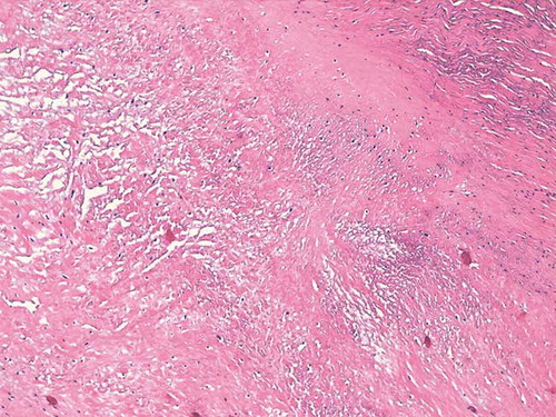 Figure 5. The histopathological image of Brucella endocarditis (surgery material).