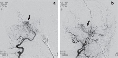 Figure 3. Cerebral angiography showing the internal carotid (a) and middle cerebral arteries (b) with a puffy collateral vascular network (arrows) typical for moyamoya disease.