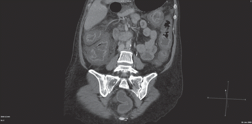 Figure 1. Abdominal CT scan with intravenous contrast shows extensive bowel wall thickening (pancolitis) with surrounding fatty stranding and ascites. Normal findings in rectum.