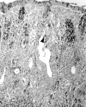 Figure 5 Micrograph of rat colon mucosa showing dilated and fused crypts with intraluminal mucus content (arrowhead) in TNBS-group. Note PMN and lymphocyte infiltration. PAS-hematoxylin, × 100.