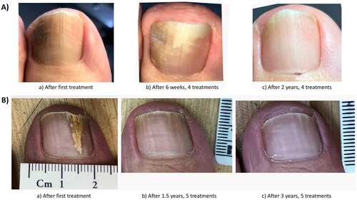 Figure 5. Photographs showing microwave treatment of toenail. Toenails of two patients treated with 4 and 5 sessions. (A) The toenail of a patient after the first microwave treatment, after 6 weeks, having received a total of 4 microwave treatments, and after 2 years follow-up. (B) The toenail of another patient after the first microwave treatment, after 1.5 years, having received 5 microwave treatments, and after 3 years at follow-up (Citation44).