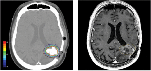 Figure 2. Postoperative CT scan of a glioblastoma patient showing magnetic nanoparticles deposits as hyperdense areas within the tumor tissue (left hand). Isothermal lines indicate calculated intratumoral temperatures for a magnetic field strength of 8.0 kA/m corresponding to an SAR of 718 W/kg (derived from the Hounsfield units in the CT scan). The brown line (right hand) represents the tumor area identified by preoperative MRI as fused with the CT scan.