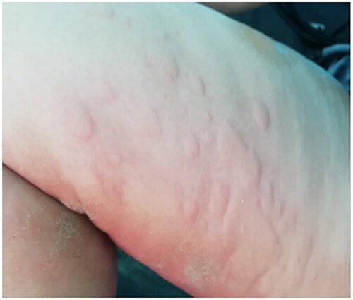 Figure 1. Extensive urticaria developing after exposure to cold.