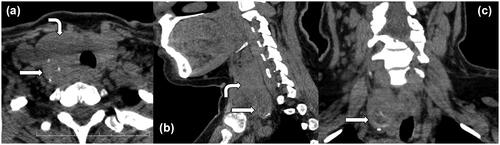 Figure 1. Non-contrast computed tomography demonstrates irregular growth in the thyroid lobes (curved arrow) and a nodule containing calcification foci in the right thyroid lobe (straight arrow); (a) axial, (b) sagittal, and (c) coronal planes of CT.