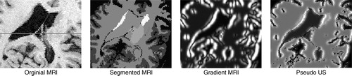 Figure 3. Generating pseudo US. The original MRI is segmented using ANIMAL, a radial gradient is then applied, and these are merged to create a pseudo US image. a) original MRI; b) segmented MRI; c) gradient MRI; d) pseudo US.