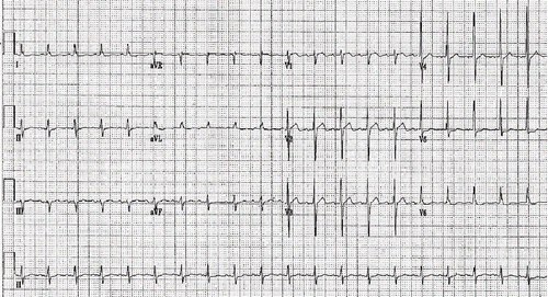 Fig. 3.  Post-resuscitation ECG.