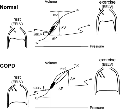 Figure 1 Pressure–volume (P–V) relationships of the total respiratory system in health and in COPD. Tidal pressure–volume curves during rest (filled area) and exercise (open area) are shown. In COPD, because of resting and dynamic hyperinflation (a further increased EELV), exercise tidal volume (VT) encroaches on the upper, alinear extreme of the respiratory system's P-V curve where there is increased elastic loading. In COPD, the ability to further expand VT is reduced, i.e., inspiratory reserve volume (IRV) is diminished. In contrast to health, the combined recoil pressure of the lungs and chest wall in hyperinflated patients with COPD is inwardly directed during both rest and exercise; this results in an inspiratory threshold load on the inspiratory muscles. Abbreviations:EELV = end-expiratory lung volume EILV = end-inspiratory lung volume; RV = residual volume; TLC = total lung capacity.