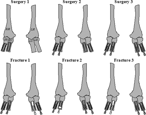 Figure 2. The fixtures over time, with the white fixtures and abutments corresponding to the interventions and changed parts. RH, LH: right and left humerus; RR, LR: right and left radial; RU, LU: right and left ulna.