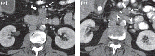 Figure 1. (a). Portovenous phase axial CT pancreas with oral and IV contrast at the time of the initial diagnosis. The CT shows a 2.5 cm exophytic mass arising from the uncinate process of the pancreas (white arrow) which abuts, but does not encase, the superior mesenteric vein and artery (broken arrow). The mass is contiguous with the third part of the duodenum (arrow head). (b). Portovenous phase axial CT pancreas with oral and IV contrast. Following treatment with concurrent gemcitabine and radiotherapy, the mass has decreased in size measuring 2 cm (white arrow). There is now a definitive fat plane between the pancreatic lesion and the third part of the duodenum (arrow head). The tumour abuts but does not encase the superior mesenteric vein and artery (broken arrow). A biliary drain can be seen in the duodenum.