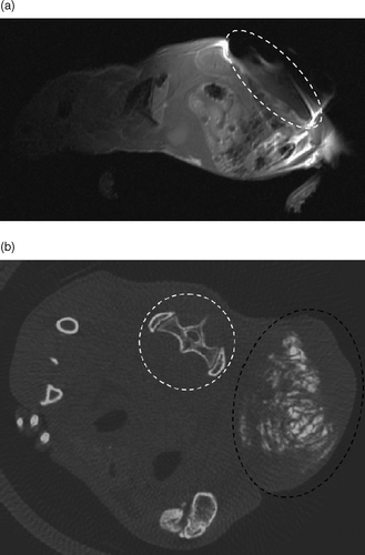 Figure 4. Implant imaging. (a), MRI imaging of a swiss nude mouse bearing a subcutaneous tumor injected with 0.25 ml of the implant formulation, with a T1 weighted sequence. The tumor zone is enclosed in the dotted white circle, highlighting the susceptibility artifact caused by SPION entrapped in the implant. (b), Micro-computerized tomography of a swiss nude mouse bearing a subcutaneous tumor punctured with 0.25 ml of the implant formulation. In the transversal, section, we can precisely localize the implant (in white) and the tumor that is enclosed within the dotted black circle. The SPIONs entrapped in the implant allowed for X-ray absorption with an absorption density close to that of bone (see, for instance, the spinal vertebrae and iliac wing highlighted by the dotted white circle). Note that the window is adjusted for bone density without further soft tissue contrast refinements or the use of contrast agent.