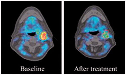 Figure 11. Hypoxia PET before and after hypoxia targeting drug (HyTD).