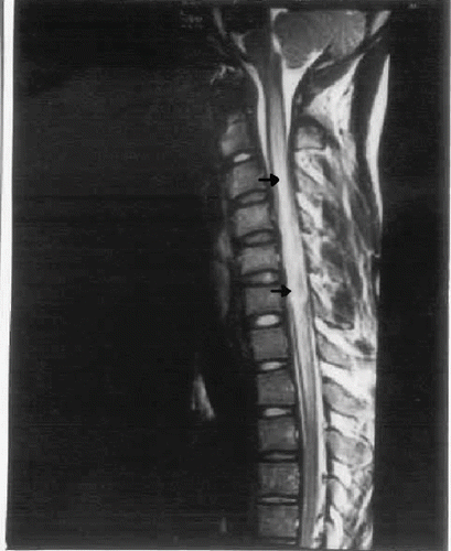 FIG. 1. MRI of the cervical spine showing expanded cervical cord with patchy increased intramedullary signal intensity (see arrows) extending from C2 to D1 level with effacement of ventral and dorsal subarachnoid spaces suggestive of transverse myelitis.