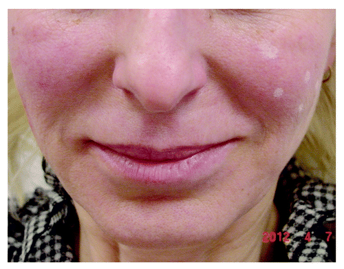 Figure 2. Patient showing the difference of the nasolabial fold: non-treated left side (with site marks for planned HA injection) and right side straight after injection of only 0.5 ml of nonanimal stabilized cross-linked HA (“Stalagmite” technique on the right cheek).