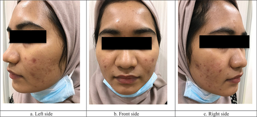 Figure 1. Photo of the face before RFM treatment.
