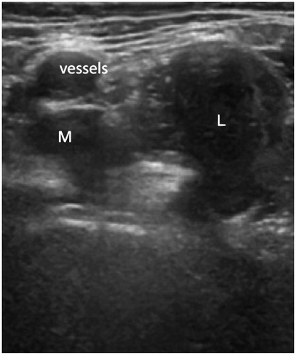 Pseudotumor in association with a metal-on-metal hip resurfacing arthroplasty identified on ultrasound examination. Anterior view of the hip demonstrating an enlarged mixed pseudotumor lying in the psoas bursa region. The pseudotumor lies in close proximity to the femoral vessels (marked) and has a smaller medial (M) and a larger lateral (L) component.