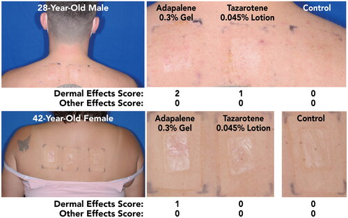 Figure 3. Participant Photographs at Final Assessment in Participants With Acne (Study 1; Visit 6; Day 12). Individual results may vary.