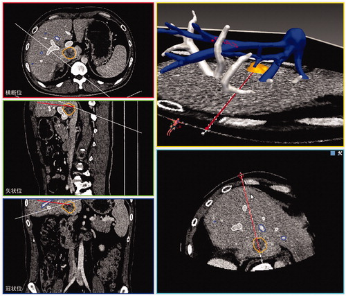 Figure 2. The interface of 3D visualisation preoperative treatment planning software. The interface displayed the real-time simulation ultrasound 2D guided planning and the 3D visualisation planning, as well as the planning path from the transverse, coronal and sagittal plane.