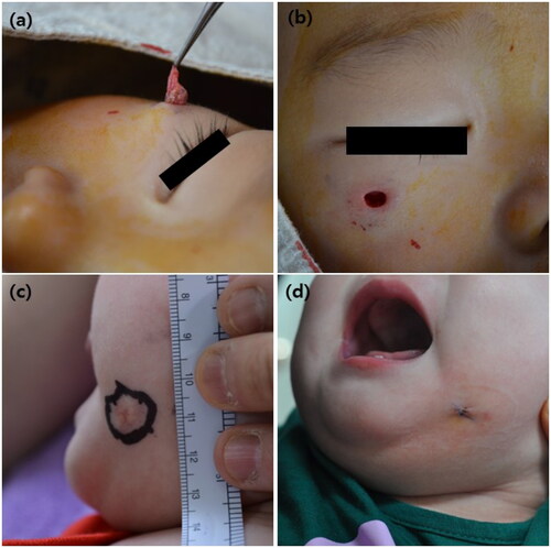 Figure 1. Clinical images of the punch incision method. Patient 1: (a) removal of the main mass. (b) Appearance of the defect after inspection to ensure that the lesion is removed. Patient 2: (c) clinical manifestation of pilomatricoma before punch incision and long axis of the lesion (1.5 cm). (d) Clinical image taken after wound closure; the wound length did not exceed 0.6 cm.