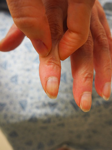 Figure 11 Preservation of mobility of the skin between the distal interphalangeal and proximal interphalangeal joints can help distinguish eosinophilic fasciitis from systemic sclerosis.