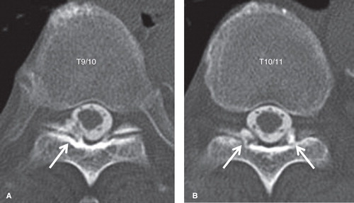 Figure 3. CT images after conventional myelography of the thoracic spine. OLF at the right T9–10 (A) and bilateral T10–11 (B) levels were observed (arrows).