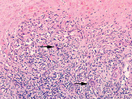 Figure 3.  Macrophage and giant cell (arrowed) granulomatous response around an area of coagulative necrosis (top) in a case of MoM-implant associated pseudotumor.