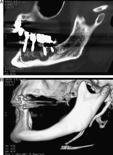 Figure 1.  A. ONJ of the left hemi-mandible. CT oblique sagittal reconstruction displayed with bone window setting showing a large osteolyitic lesion with a sequestrum in the site of four dental implants, B. Follow-up CT 3D reconstruction five months after surgical resection of necrotic bone.