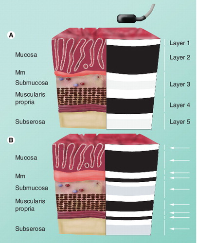 Figure 2. Relationship between histological and ultrasonographic gastrointestinal wall layers.(A) The ultrasonographic five-layer and (B) nine-layer gastrointestinal wall structure. The interface echoes of the ultrasound image will appear continuous with the echo-rich wall layers. By thickening of the Mm and a visible interface echo generated between the inner and outer part of the muscularis propria, up to nine different layers can be separated by ultrasonography.Mm: Muscularis mucosae.Reproduced with permission from Citation[56].