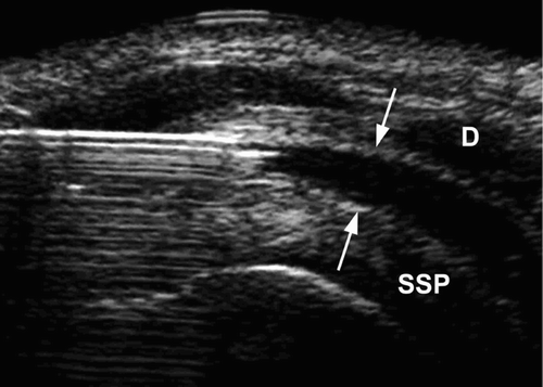 Figure 1B. Ultrasonographic image after injection of about 5 ml of fluid (arrows) into the subacromial-subdeltoid bursa. D: deltoid muscle; SSP: supraspinatus tendon.