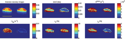 Figure 3. Example of images (inversion recovery with TI = 2400 ms) and parameter maps produced by kinetic analysis: IAUC, Ktrans, kep, ve, and vp. The images are produced for the same 200 mm3 KHT sarcoma before (left) and 3 hours after treatment with CA4DP (right). On the inversion recovery images, the light blue color shows the leg visible to the left of the tumor and the foot below the tumor, and the yellow line indicates 1 cm. The images and maps show intratumor heterogeneity and overall reduction of the vascular parameters IAUC, Ktrans, kep, and vp.