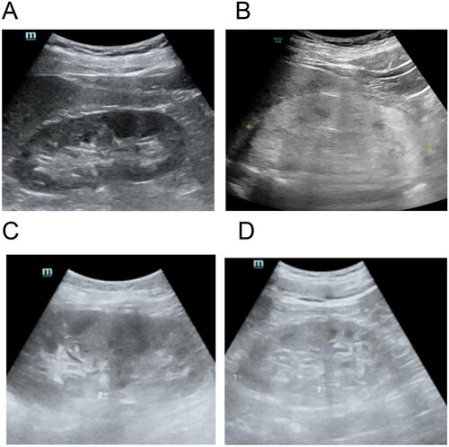 Figure 1. Kidney under ultrasound. (A) Normal human kidney. (B) The kidney of the patient reported in our case. It showed diffuse echogenic enhancement under ultrasound, with unclear corticomedullary boundary and normal kidney size, abbreviated as ‘large white kidney’. (C) Kidney with acute ischemic injury. (D) End-stage sclerosing kidney.