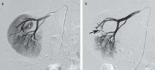 Figure 3. a. Selective angiography of the right kidney confirms a large (pseudo-)aneurysm (asterisk) in the hilum of the kidney. b. Selective angiography of the right kidney after coil-embolization (arrow): complete exclusion of the (pseudo-)aneurysm.