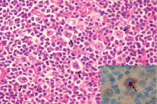 Figure 4. Reed–Sternberg cells and reactive small lymphocytes (arrows) in lymph node sections (HE, ×200). Inset: cytoplasmic CD30 positivity in Reed–Sternberg cells (ABP, CD30, ×400). ABP, avidin biotin peroxidase method. Hematoxylin eosinophil.