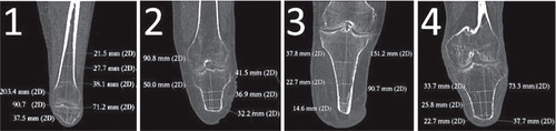Figure 1. Computed tomography scans and key measurements of the residual bones for each case.