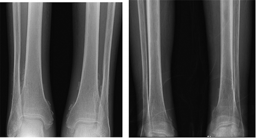 Figure 1.  Anteroposterior radiographs of both ankles showing: Left: Non-aggressive periosteal reaction in left tibia and right tibia and fibula. Right: Improvement after anakinra therapy.