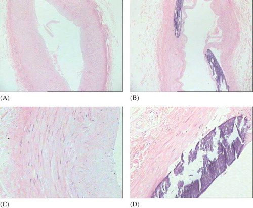 Figure 1.  Hematoxylin and eosin staining of the radial artery.Notes: The calcification was located in the tunica media. The calcificated endangium was basically complete, and the thickening of tunica media can be seen and was significantly correlated with the increase of calcification. The differences among noncalcification, mild to moderate calcification, and severe calcification groups were statistically significant (p < 0.05).