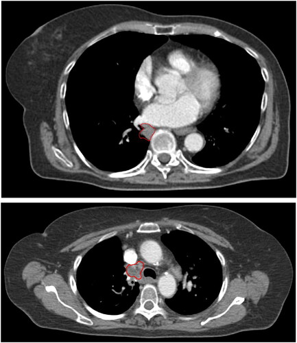Figure 1. Planning CT scans of solitary lung tumour (upper panel) and lymph node target (lower panel). the GTVs are delineated in red.