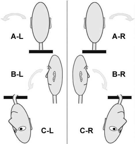 Figure 2 The Dix-Hallpike test, for the left (L) ear on the left panel and for the right (R) ear on the right panel.
